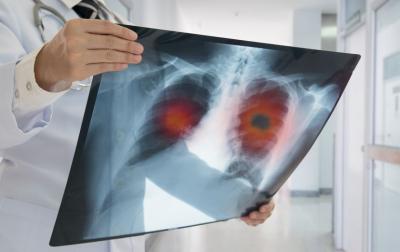 Skrining raka pluća povećava šanse obolelih da prežive: Koje kategorije su najviše ugrožene
