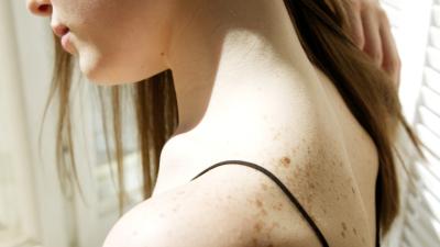 Sitne nesavršenosti na koži: Kako ih razlikovati i kako ih se rešiti