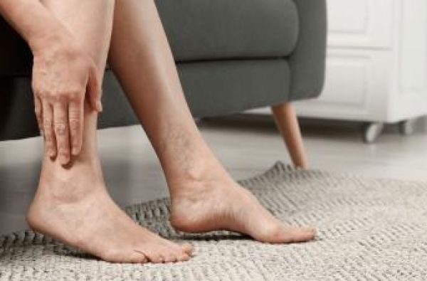 Šta je venska insuficijencija i kako kompresivne čarape pomažu?