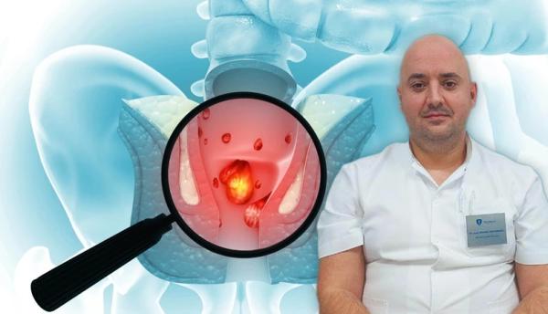 Četiri stadijuma hemoroida, za poslednja dva jedino rešenje je operacija: Savremena procedura uklanja tri glavna simptoma