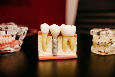 Sve što niste znali o zubnim implantima