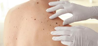 „Otkrio sam melanom jer me je svrbela koža“: Dolazi nam period opasnog UV zračenja, redovno pregledajte mladeže