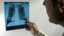 Šta moramo da znamo o tuberkulozi nakon što se pojavila među decom u Novom Pazaru