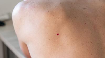 Imate ovakve crvene tačkice po koži: Ovo su razlozi zašto se pojavljuju, a evo kada da se javite lekaru