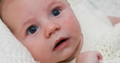Atopijski dermatitis kod beba