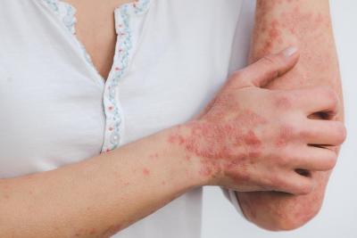 Psorijaza - šta pokreće ovu bolest kože i kako se leči?